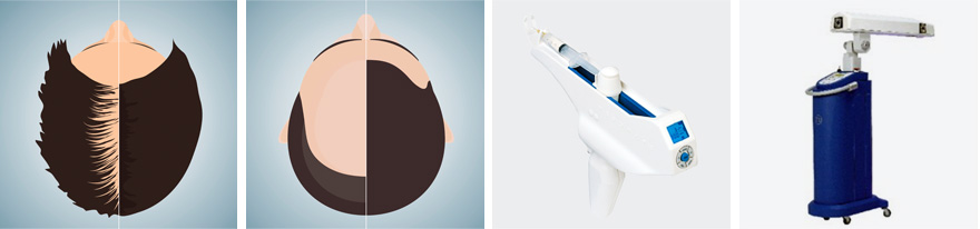 메조테라피주사, 메조테라피는 탈모를 일으키게하는 DHT로 부터 모낭을 보호해주고 모낭세포가 건강하게 무럭무럭 자랄수 있도록  얕게 주입하는 시술로 모낭에 충분한 영양과 성광인자를 공급해 줍니다.